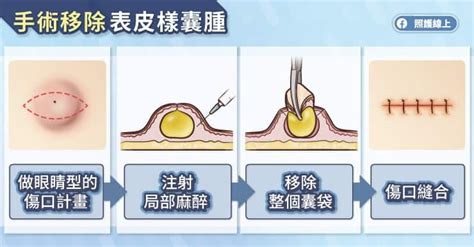 耳垂腫起來會痛|健康網》耳垂「小豆」是表皮囊腫！ 醫：勿亂擠 和平共存即可